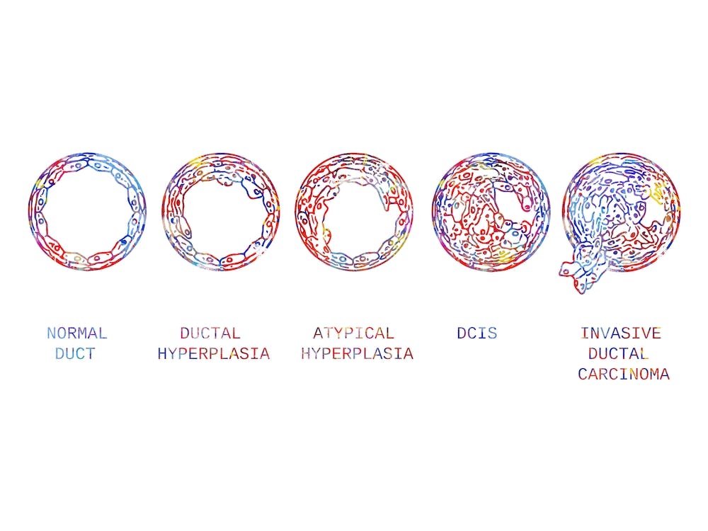 Normal Breast And Breast Cancer Types Watercolor